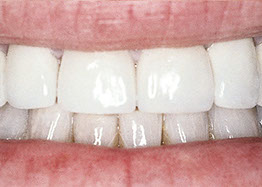 Veneers after