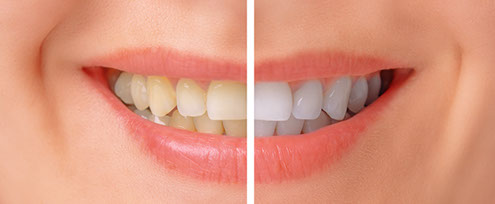 Whitening before and after image